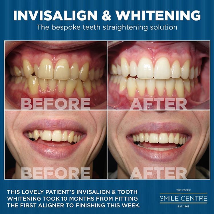 Smile Gallery The Essex Smile Centre