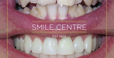 Invisalign by Dr Declan