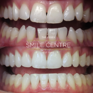 Invisalign by Dr Stephen