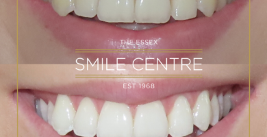Teeth Whitening by Dr Declan
